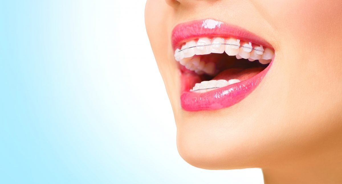 Replacement of missing teeth