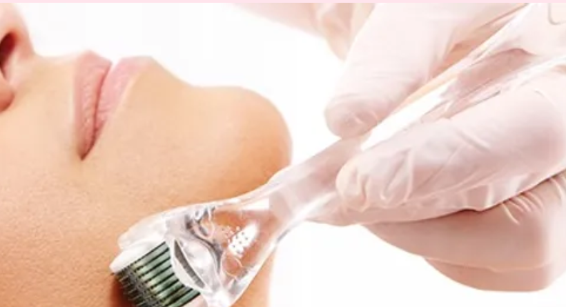 microneedling almere