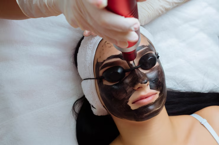 carbon facial treatment